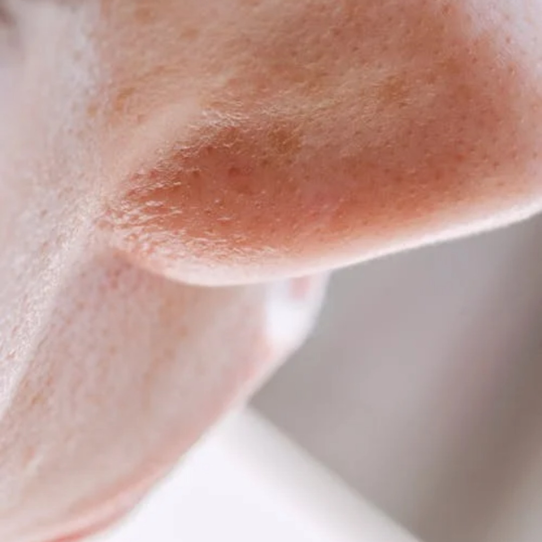 Open Pores Treatment